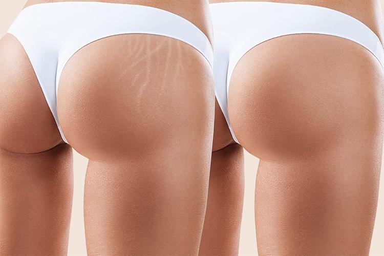 Traitement vergetures corps Pure Skin Belgium Waterloo